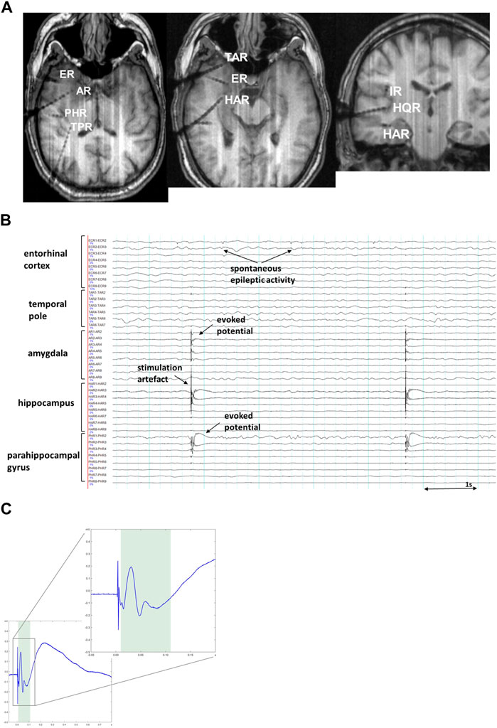 Physiological and pathological neuronal connectivity in the living human brain based on intracranial EEG signals: the current state of research